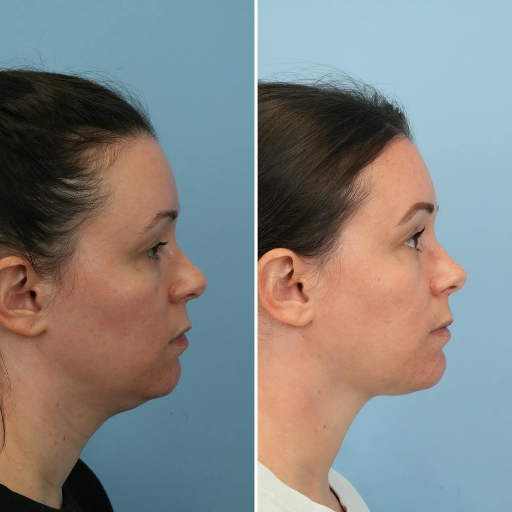 Submental Liposuction Before & After Gallery - Patient 366655 - Image 4