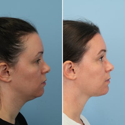 Submental Liposuction Before & After Gallery - Patient 366655 - Image 4