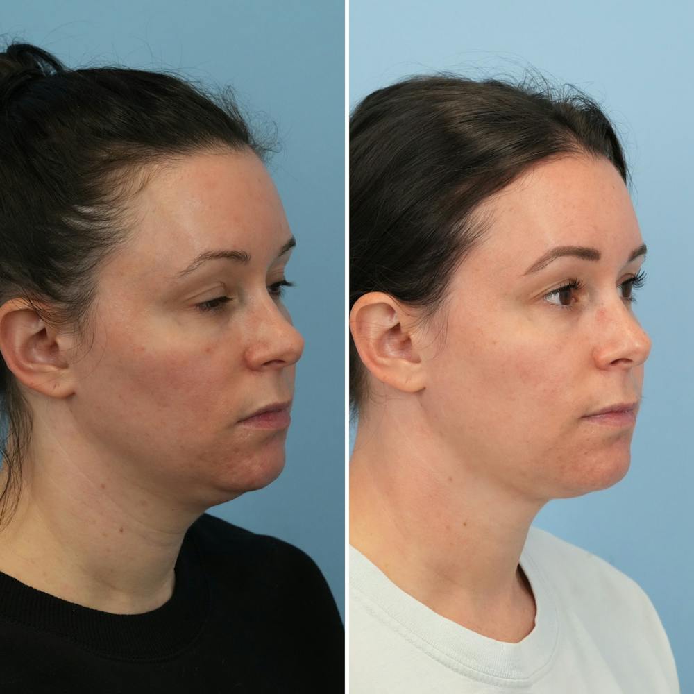 Submental Liposuction Before & After Gallery - Patient 366655 - Image 3