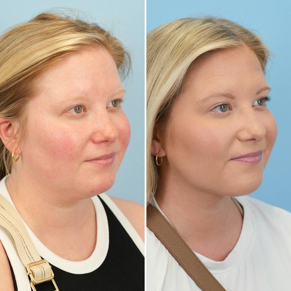 Submental Liposuction Before & After Gallery - Patient 289429 - Image 4
