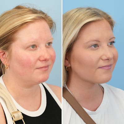 Submental Liposuction Before & After Gallery - Patient 289429 - Image 4