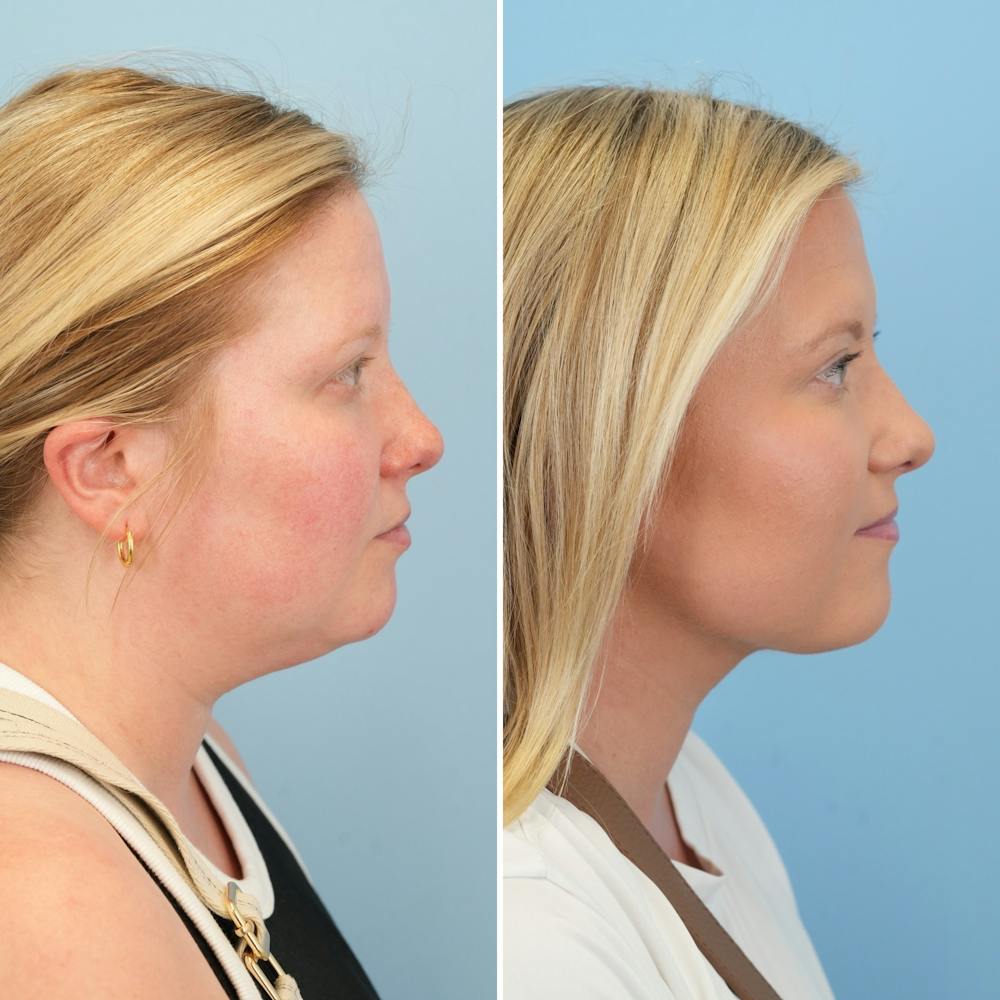 Submental Liposuction Before & After Gallery - Patient 289429 - Image 5