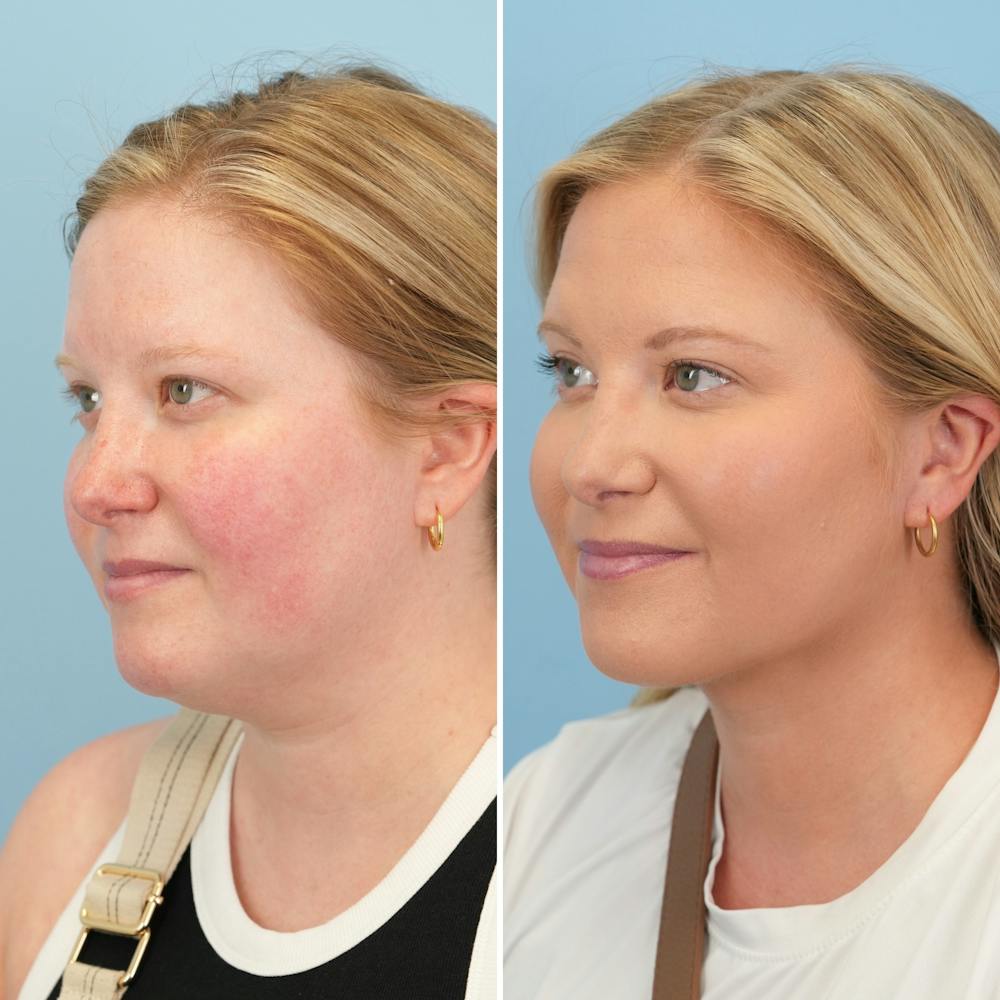 Submental Liposuction Before & After Gallery - Patient 289429 - Image 2