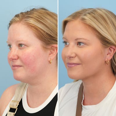 Submental Liposuction Before & After Gallery - Patient 289429 - Image 2