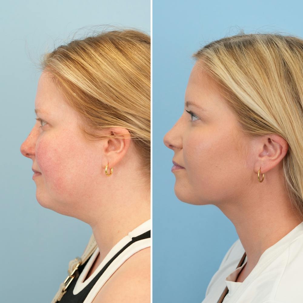 Submental Liposuction Before & After Gallery - Patient 289429 - Image 1