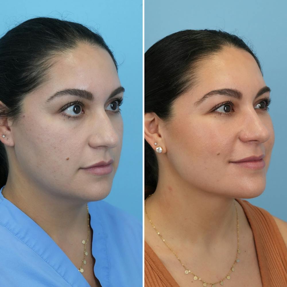 Submental Liposuction Before & After Gallery - Patient 235795 - Image 4