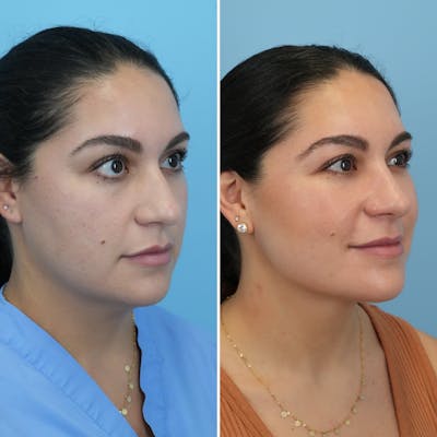 Submental Liposuction Before & After Gallery - Patient 235795 - Image 4
