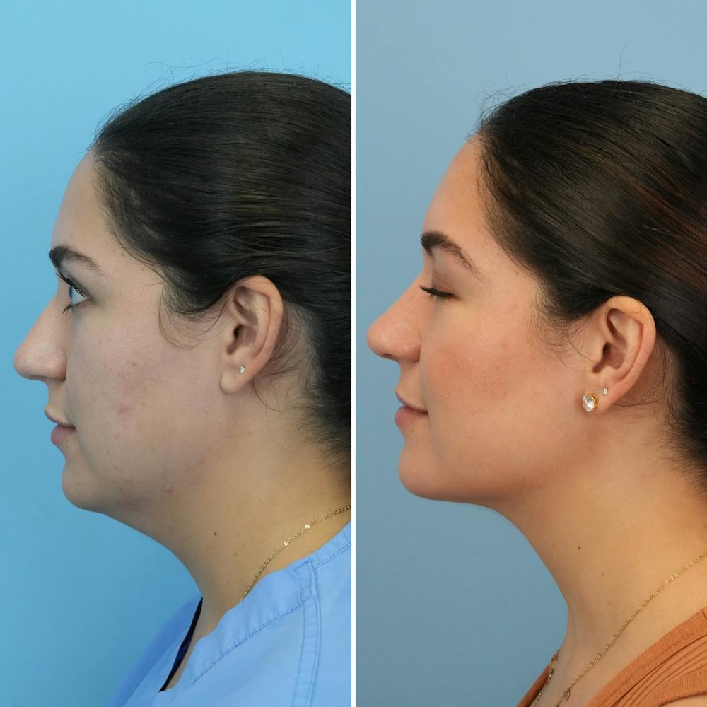 Submental Liposuction Before & After Gallery - Patient 235795 - Image 1