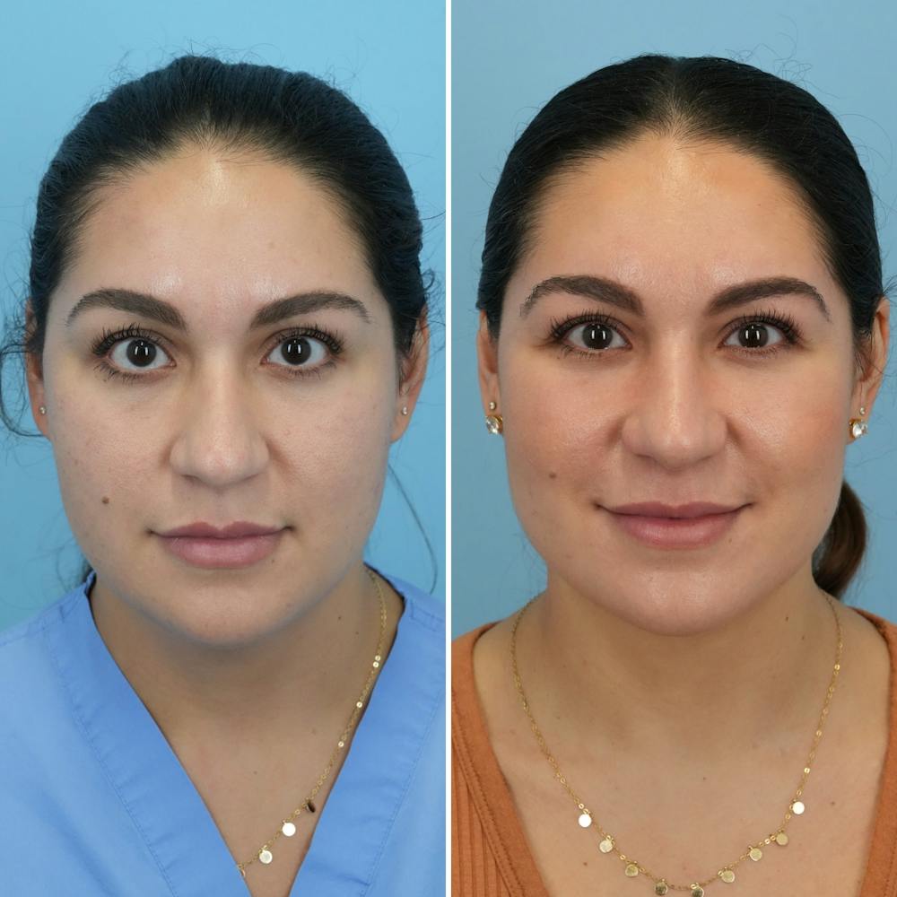 Submental Liposuction Before & After Gallery - Patient 235795 - Image 3