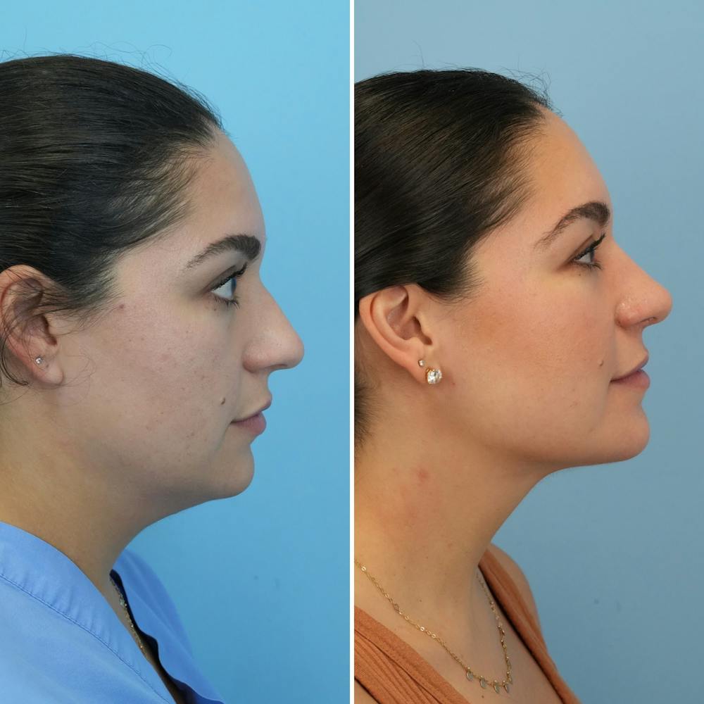 Submental Liposuction Before & After Gallery - Patient 235795 - Image 5
