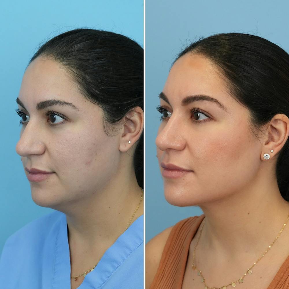 Submental Liposuction Before & After Gallery - Patient 235795 - Image 2