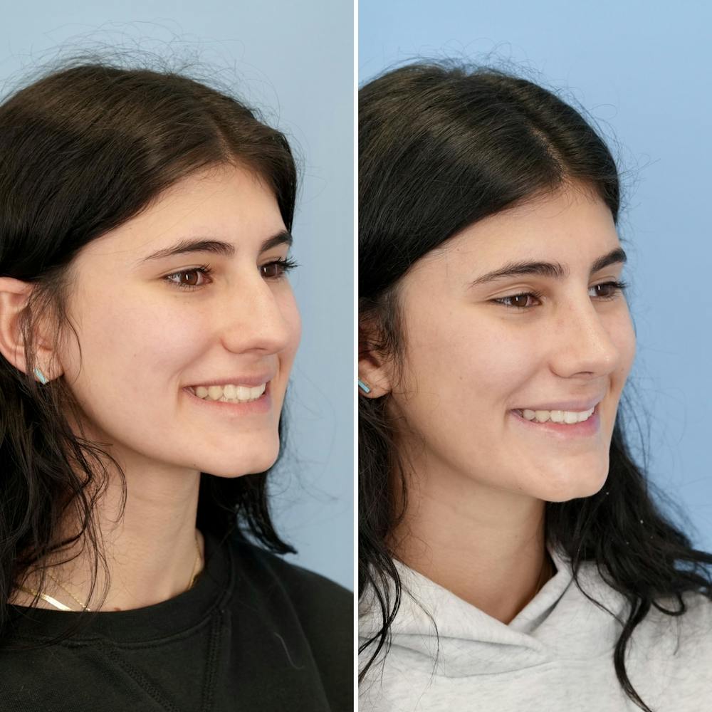 Rhinoplasty Before & After Gallery - Patient 193059 - Image 4