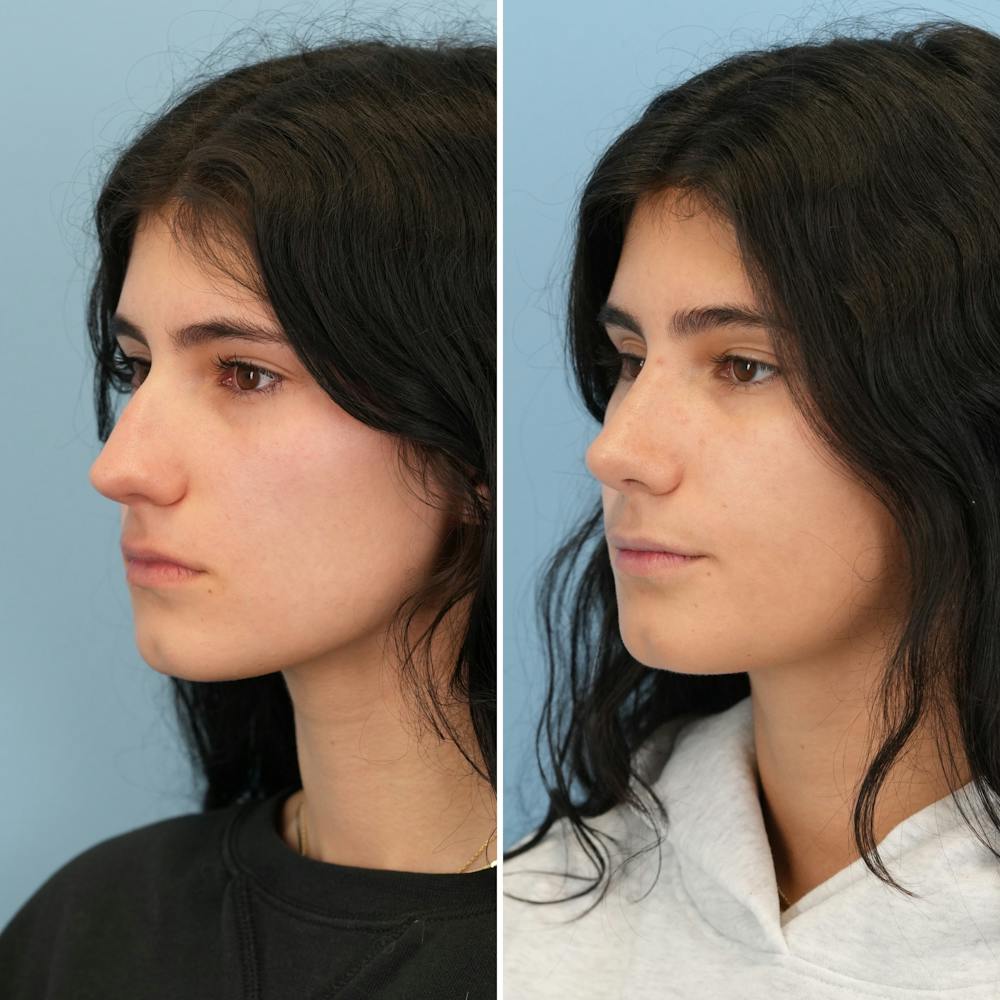 Rhinoplasty Before & After Gallery - Patient 193059 - Image 6
