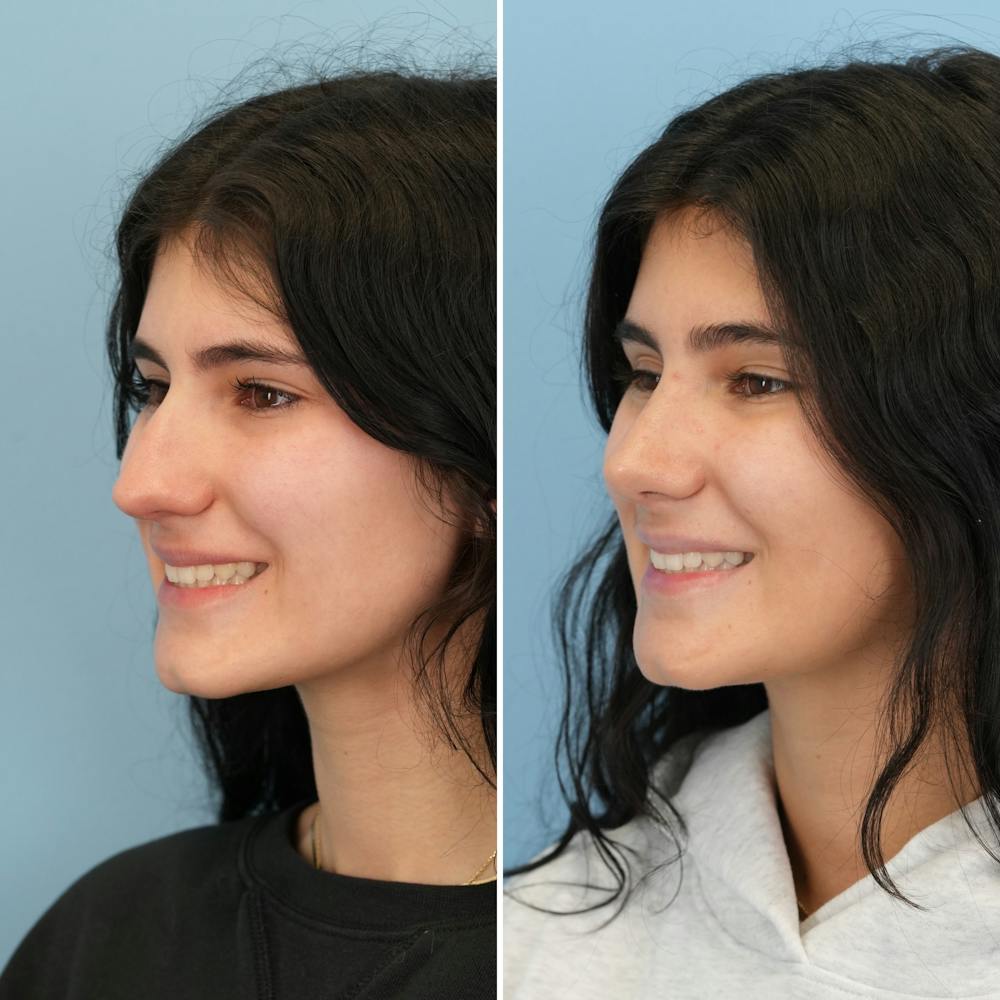Rhinoplasty Before & After Gallery - Patient 193059 - Image 7