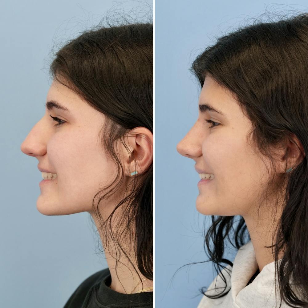 Rhinoplasty Before & After Gallery - Patient 193059 - Image 9