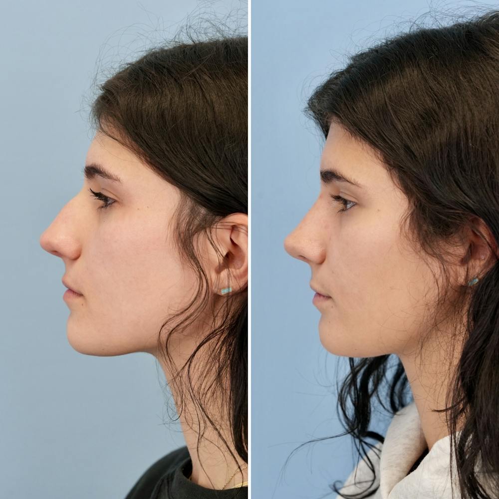 Rhinoplasty Before & After Gallery - Patient 193059 - Image 8