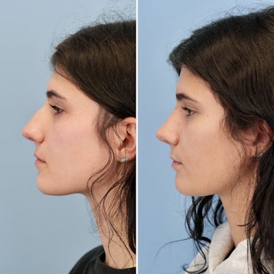 Rhinoplasty Before & After Gallery - Patient 193059 - Image 8