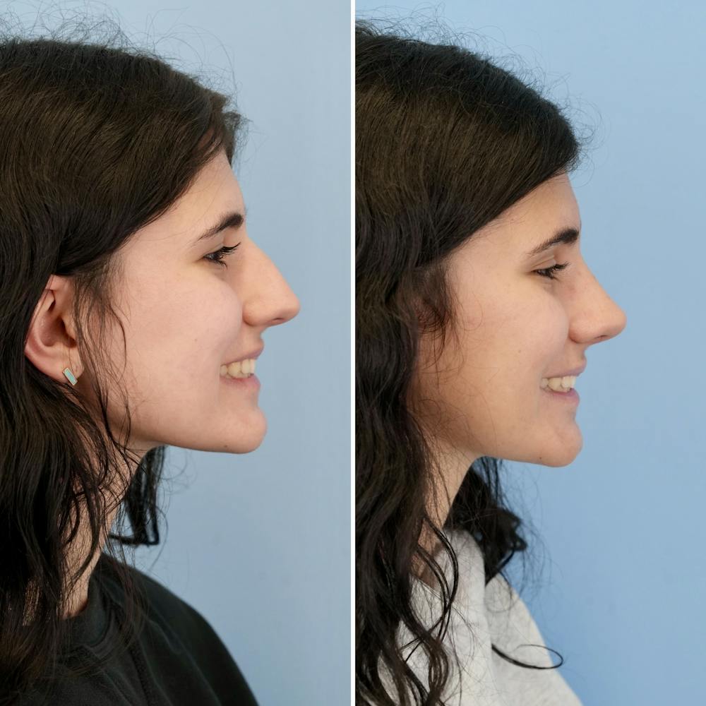 Rhinoplasty Before & After Gallery - Patient 193059 - Image 2