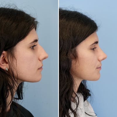 Rhinoplasty Before & After Gallery - Patient 193059 - Image 1