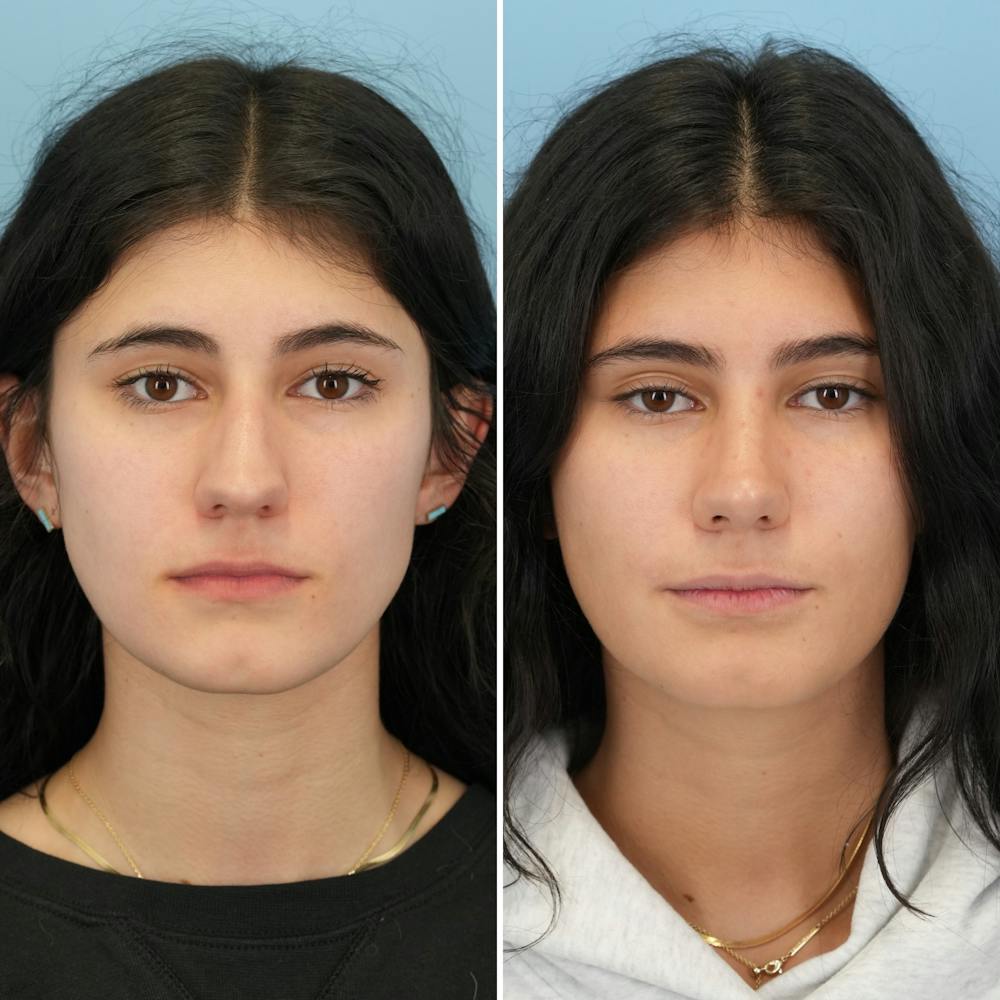 Rhinoplasty Before & After Gallery - Patient 193059 - Image 5