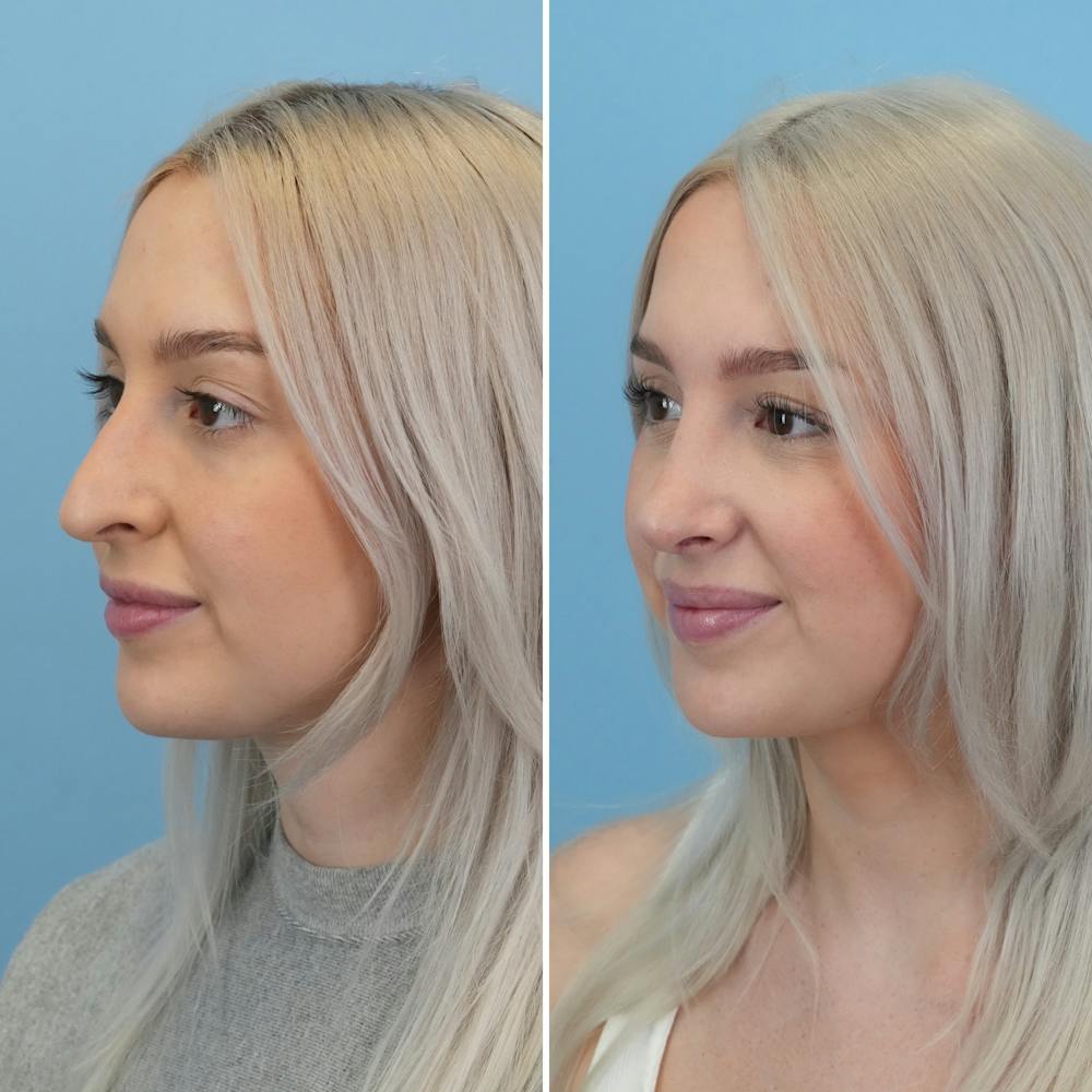 Rhinoplasty Before & After Gallery - Patient 268289 - Image 5