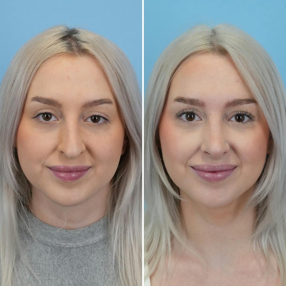 Rhinoplasty Before & After Gallery - Patient 268289 - Image 4