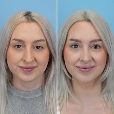 Rhinoplasty Before & After Gallery - Patient 268289 - Image 4