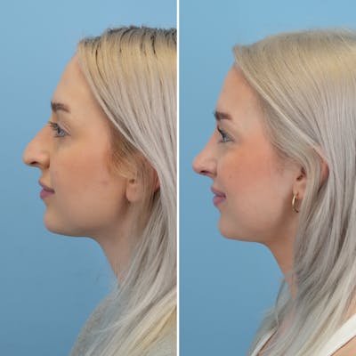 Rhinoplasty Before & After Gallery - Patient 268289 - Image 6
