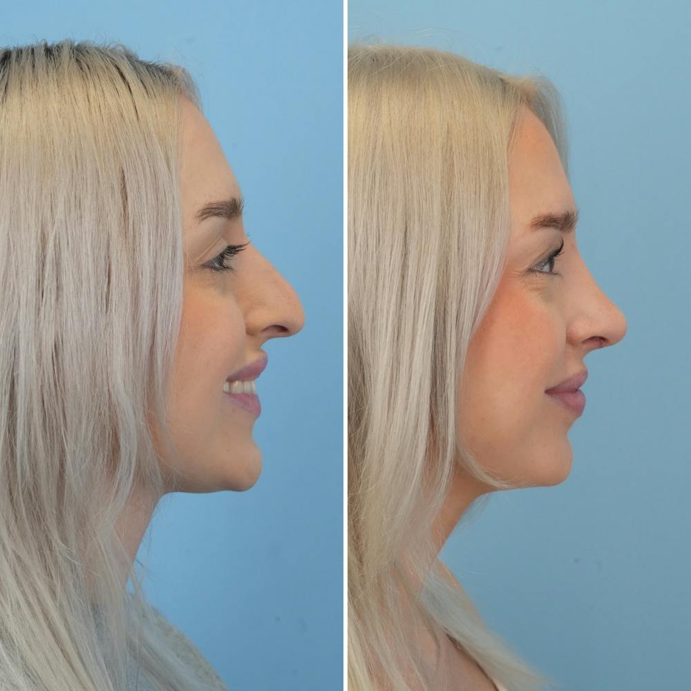 Rhinoplasty Before & After Gallery - Patient 268289 - Image 2