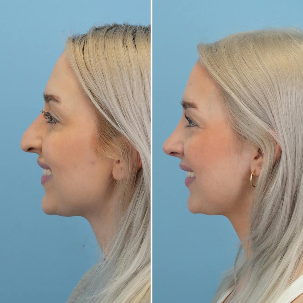 Rhinoplasty Before & After Gallery - Patient 268289 - Image 7