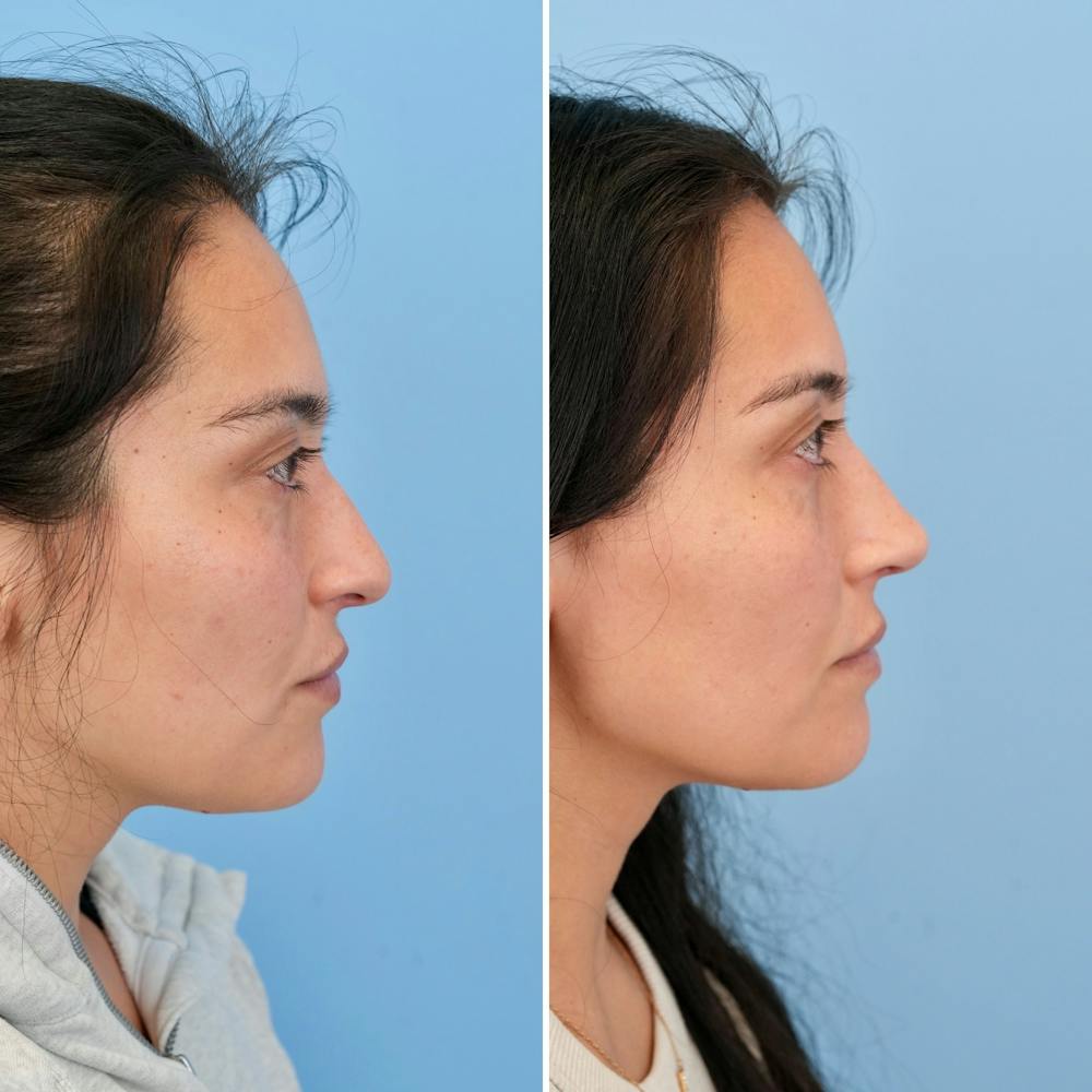 Rhinoplasty Before & After Gallery - Patient 421107 - Image 1