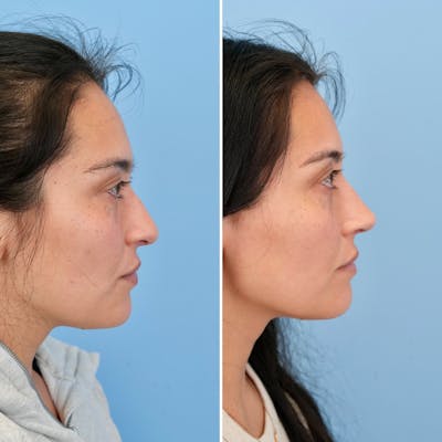 Rhinoplasty Before & After Gallery - Patient 421107 - Image 1