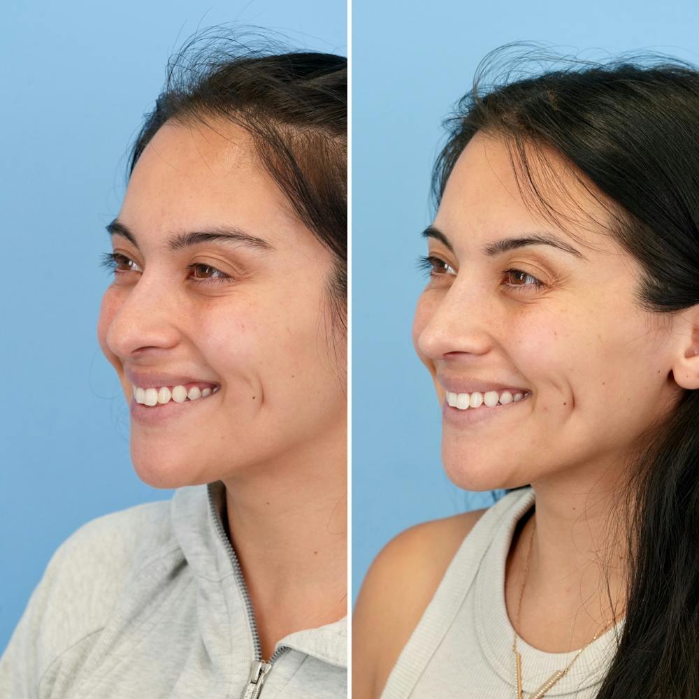 Rhinoplasty Before & After Gallery - Patient 421107 - Image 7
