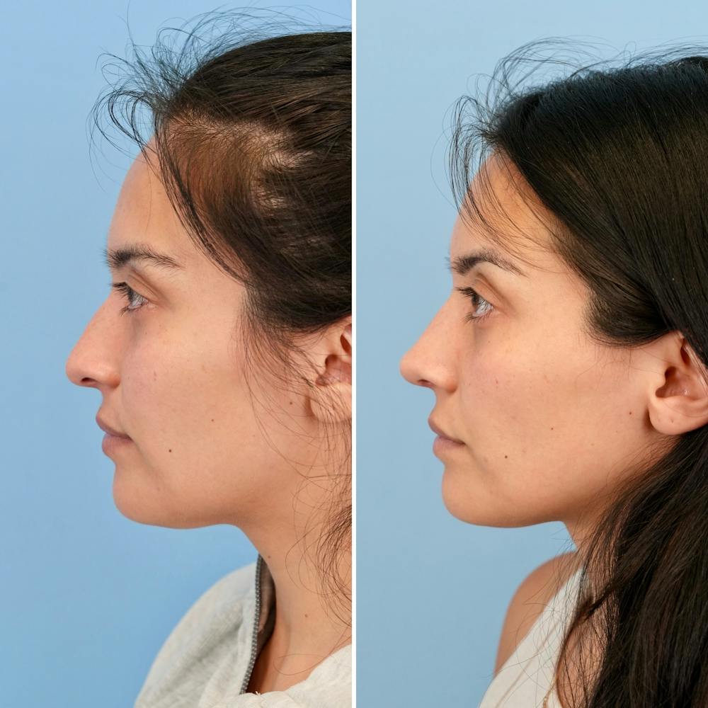 Rhinoplasty Before & After Gallery - Patient 421107 - Image 8