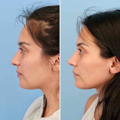 Rhinoplasty Before & After Gallery - Patient 421107 - Image 8