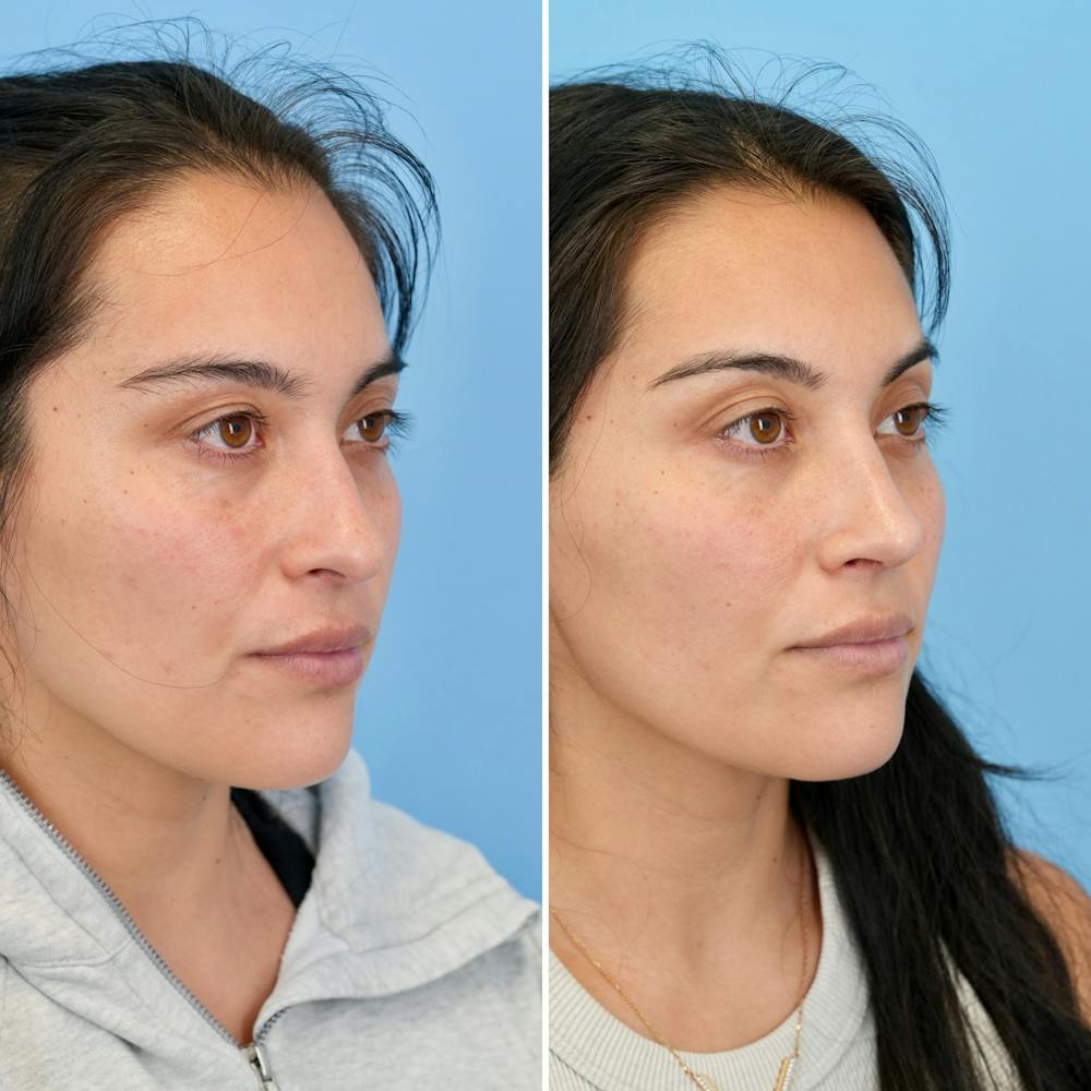 Rhinoplasty Before & After Gallery - Patient 421107 - Image 3