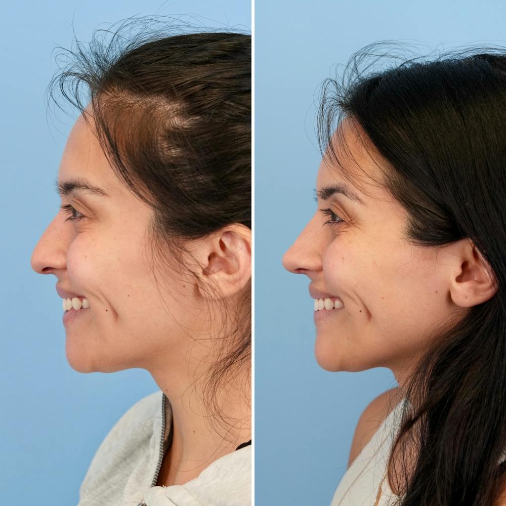 Rhinoplasty Before & After Gallery - Patient 421107 - Image 9