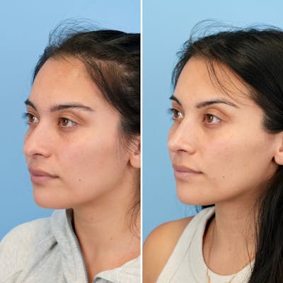 Rhinoplasty Before & After Gallery - Patient 421107 - Image 6