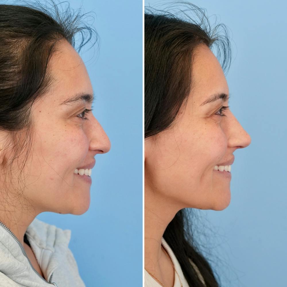 Rhinoplasty Before & After Gallery - Patient 421107 - Image 2