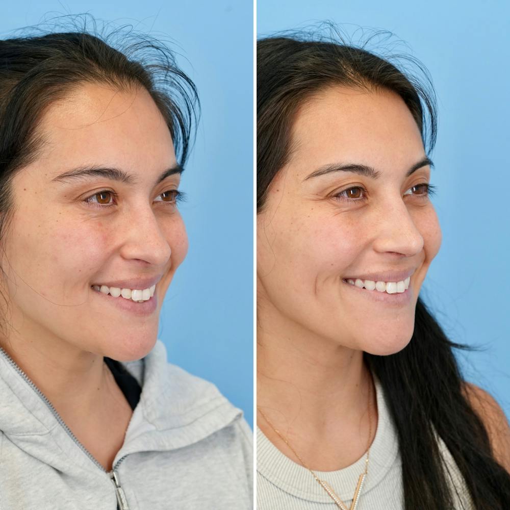 Rhinoplasty Before & After Gallery - Patient 421107 - Image 4