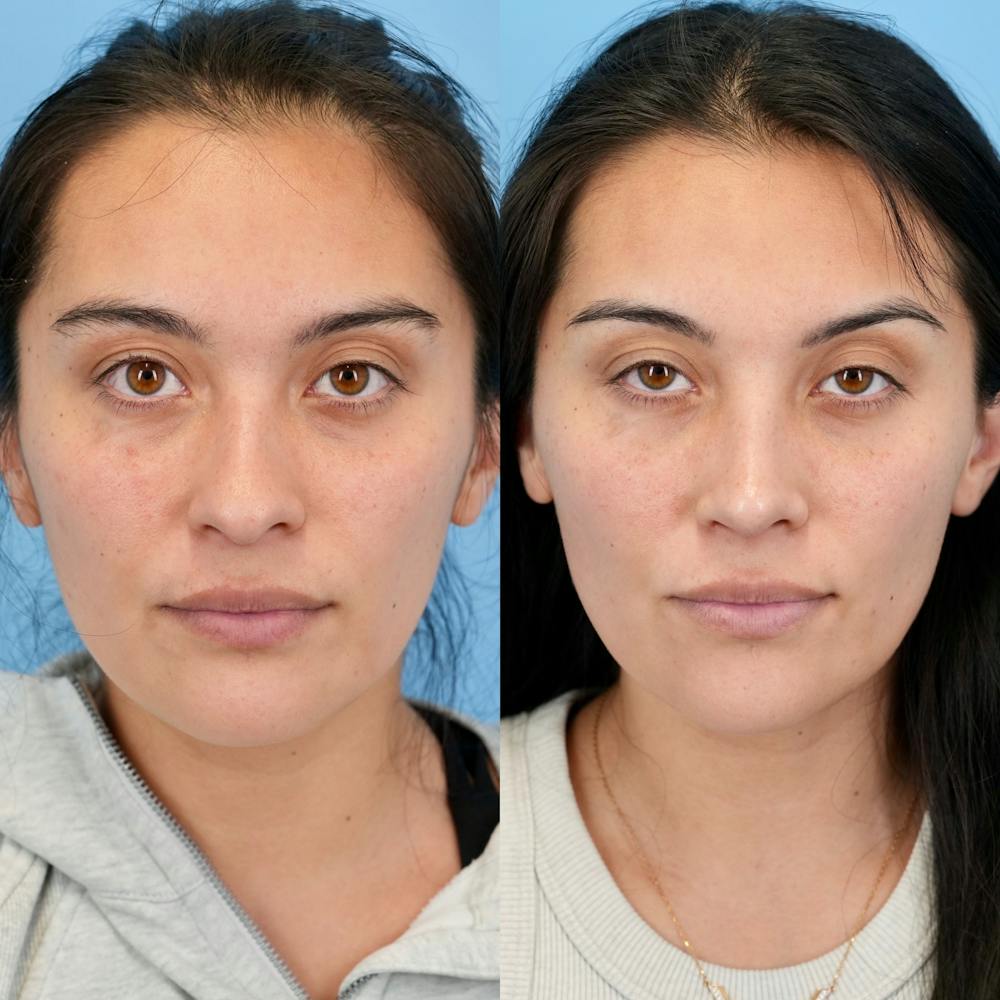 Rhinoplasty Before & After Gallery - Patient 421107 - Image 5