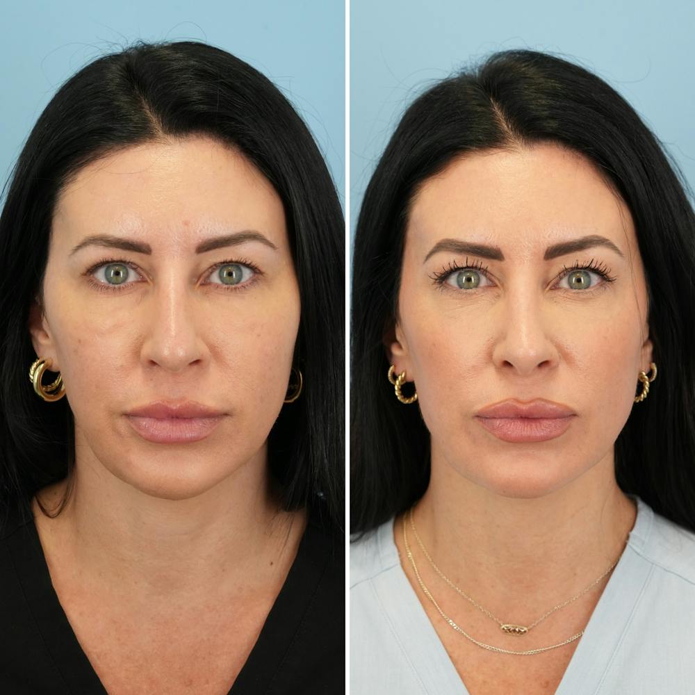 Rhinoplasty Before & After Gallery - Patient 417253 - Image 5