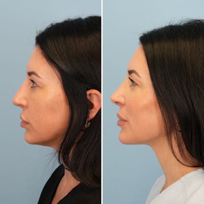 Rhinoplasty Before & After Gallery - Patient 417253 - Image 8