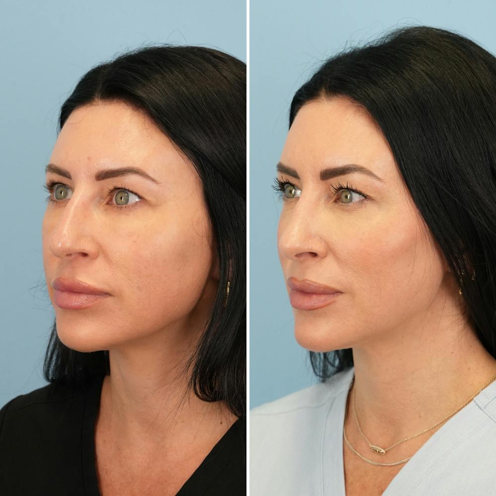 Rhinoplasty Before & After Gallery - Patient 417253 - Image 6