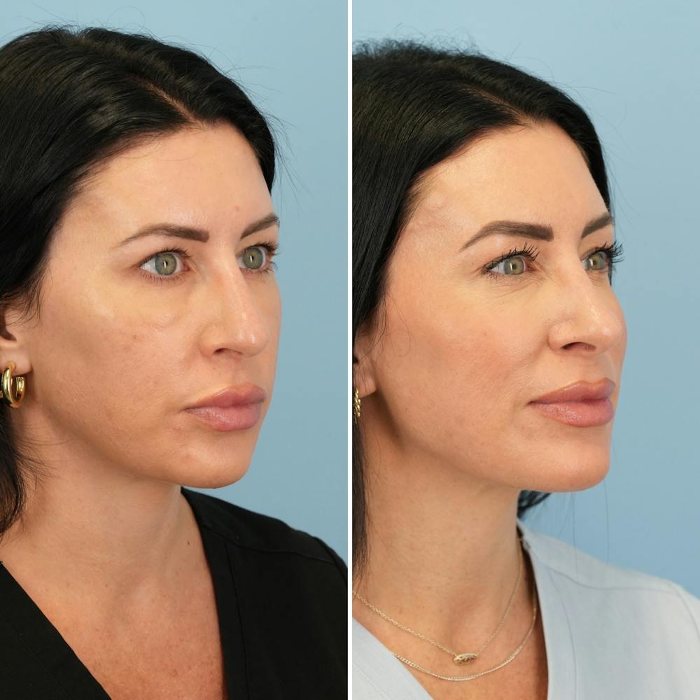 Rhinoplasty Before & After Gallery - Patient 417253 - Image 3