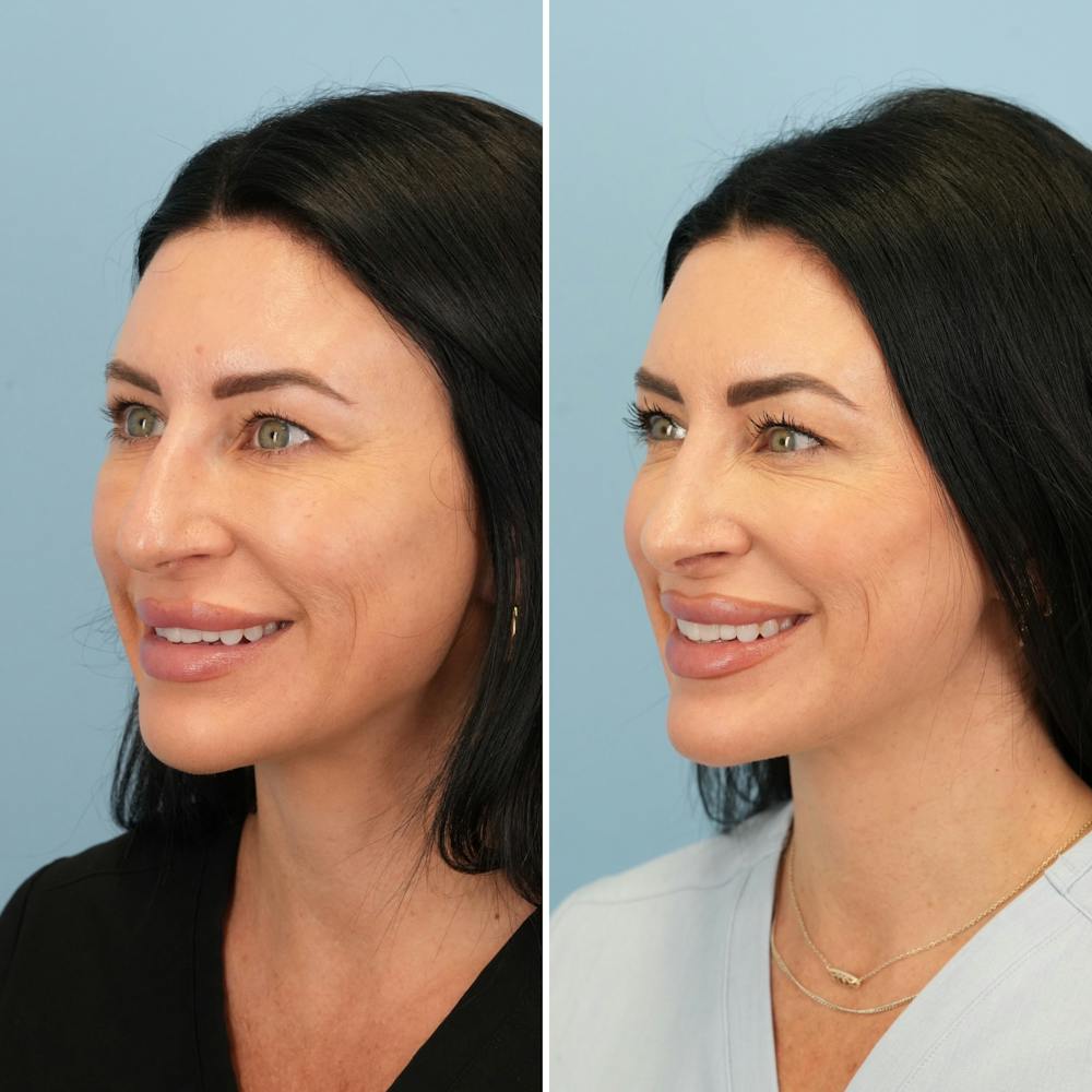 Rhinoplasty Before & After Gallery - Patient 417253 - Image 7