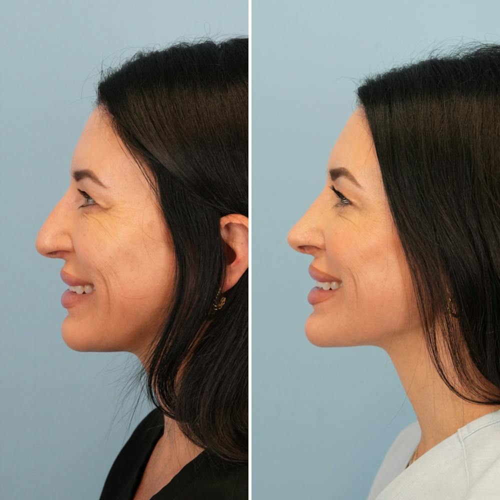 Rhinoplasty Before & After Gallery - Patient 417253 - Image 9