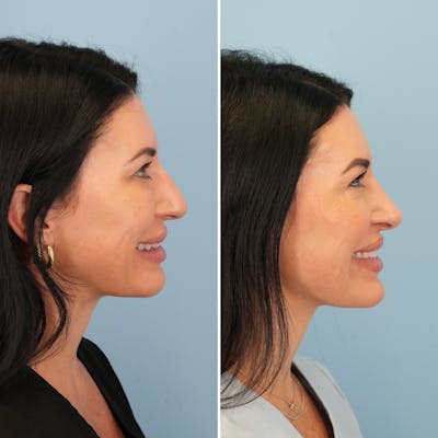 Rhinoplasty Before & After Gallery - Patient 417253 - Image 2
