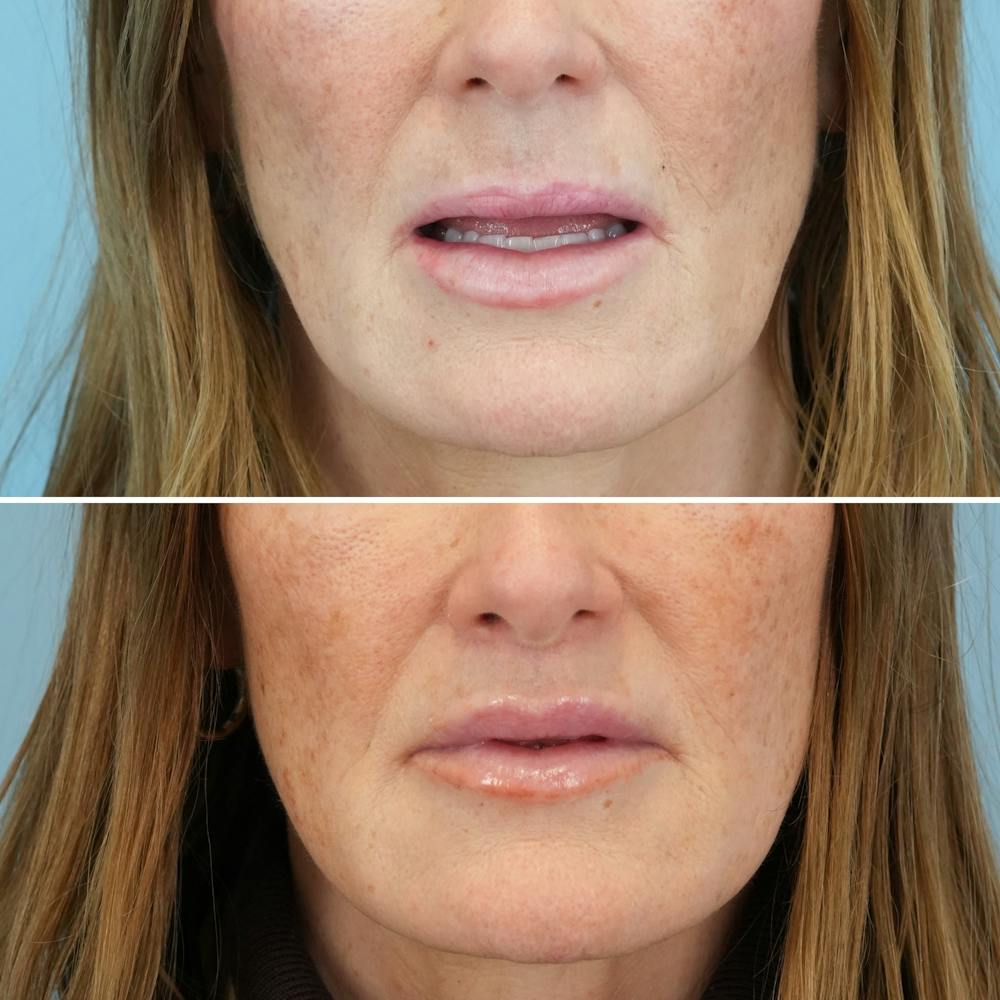 Lip Lift Before & After Gallery - Patient 141568 - Image 3