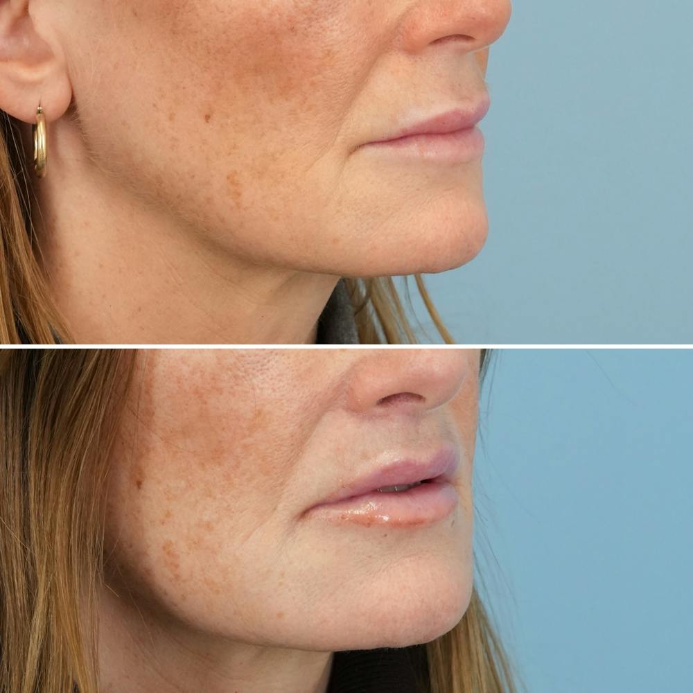 Lip Lift Before & After Gallery - Patient 141568 - Image 4